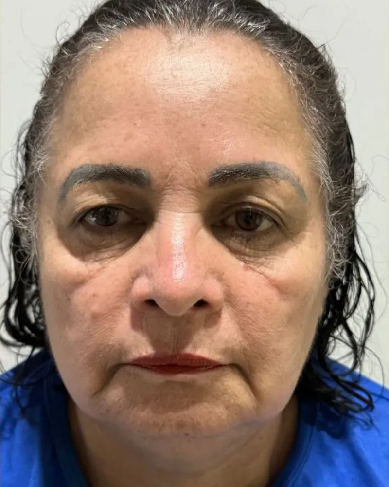 Antes — Ácido Hialurônico Facial