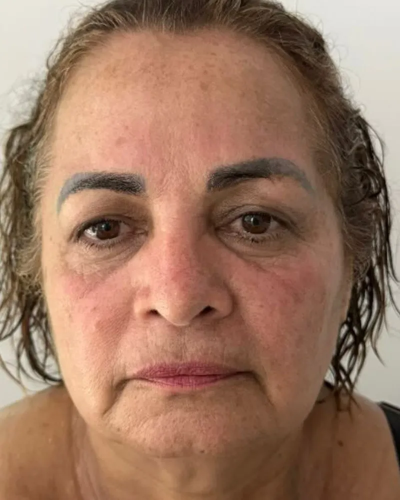 Depois — Ácido Hialurônico Facial