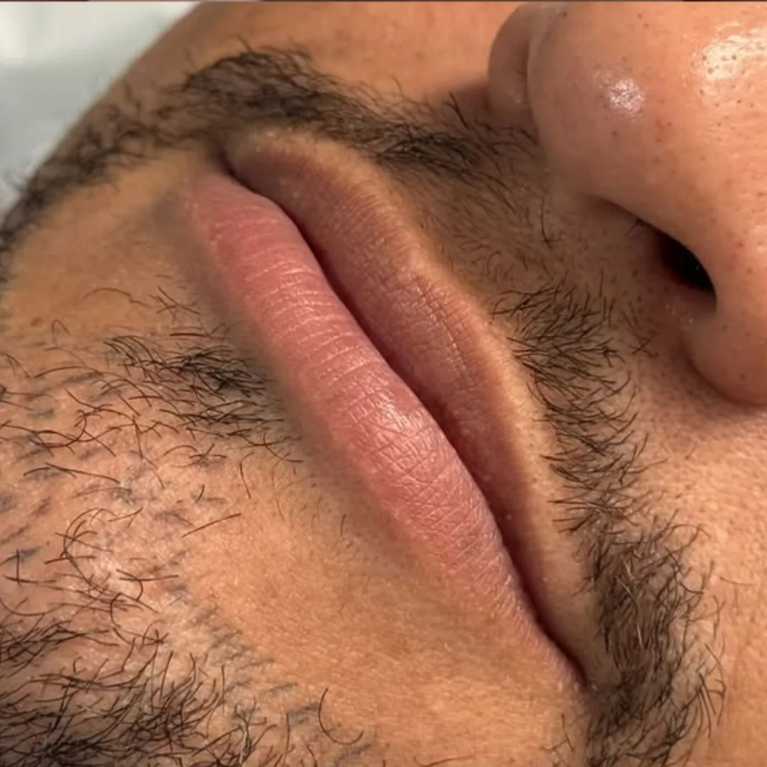 Antes — Ácido Hialurônico Facial