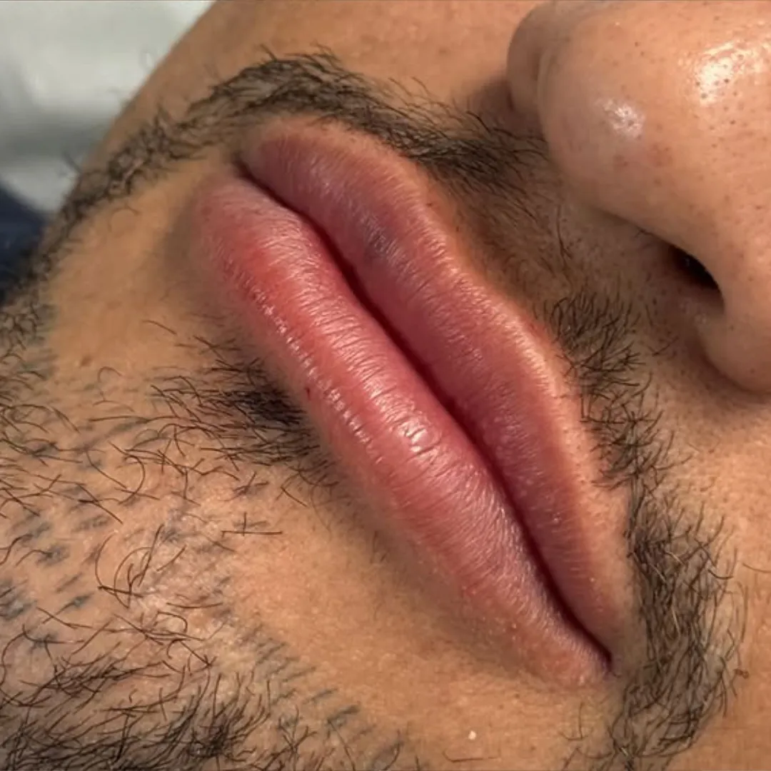 Depois — Ácido Hialurônico Facial