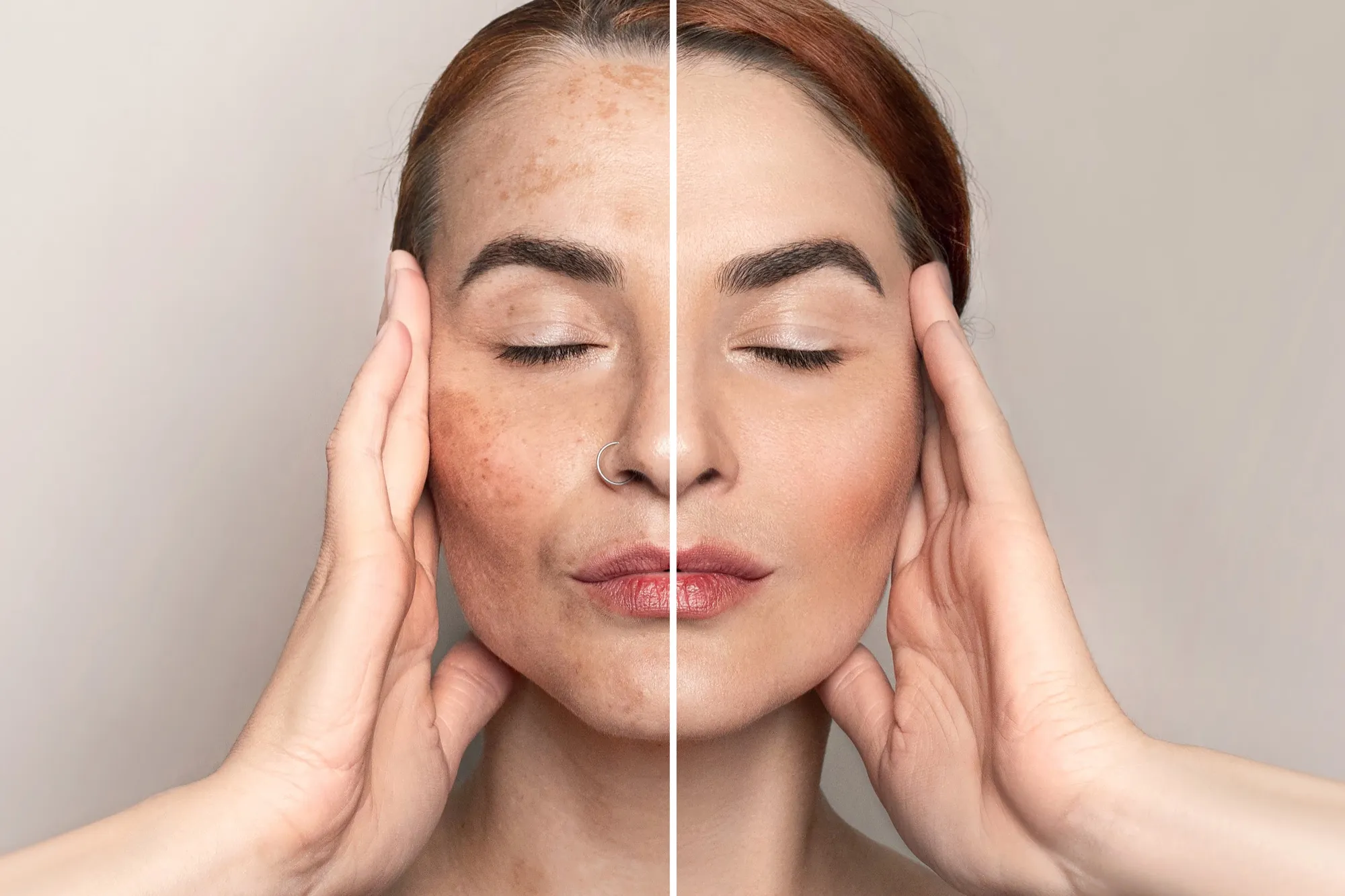 Tratamento de Melasma