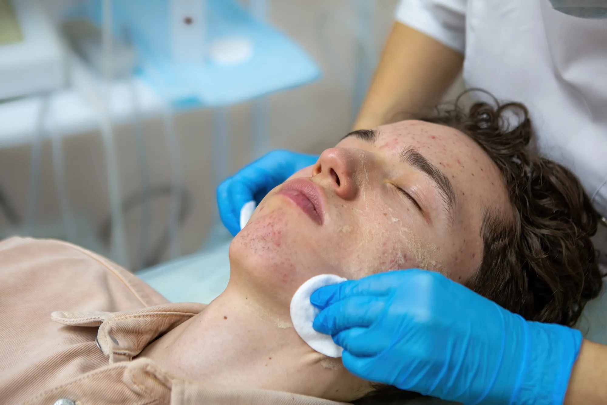 Tratamento de Acne